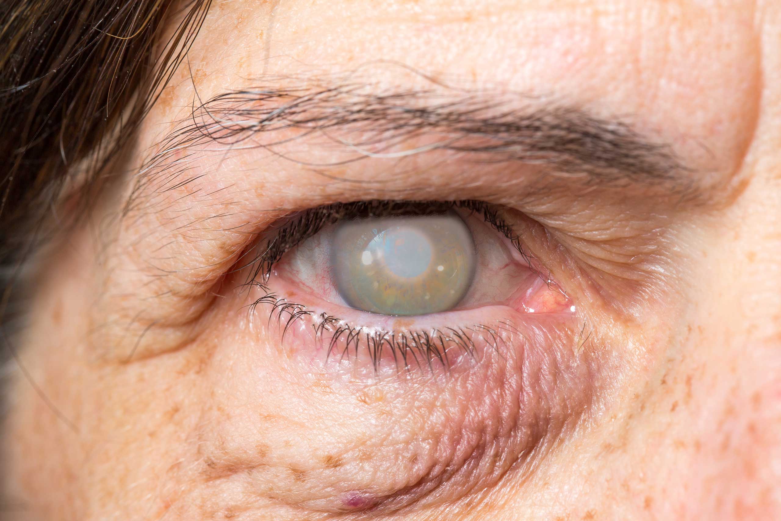 Der Graue Star (Catarakt) 